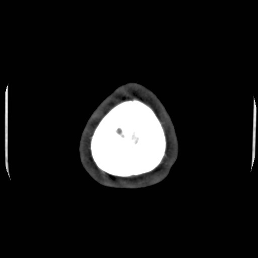 Cerebral venous sinus thrombosis (Radiopaedia 40619-43227 A 224).jpg