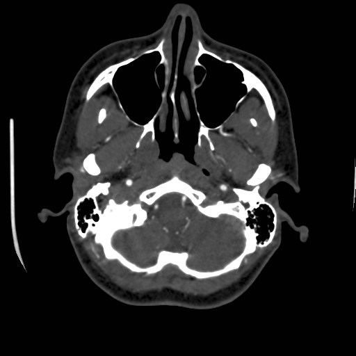 Cerebral venous sinus thrombosis (Radiopaedia 40619-43227 A 29).jpg