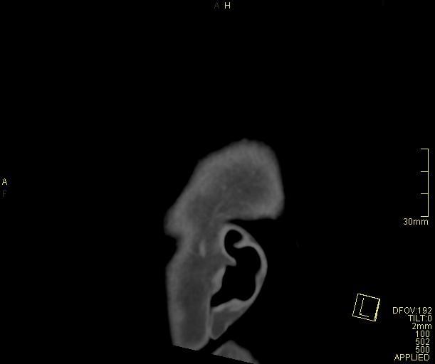 Cerebral venous sinus thrombosis (Radiopaedia 91329-108965 Sagittal venogram 75).jpg