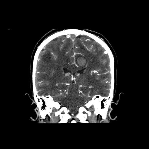 File:Cerebral venous throbmosis - hemorrhagic venous infarction (Radiopaedia 87318-103613 Coronal CT venogram 23).jpg