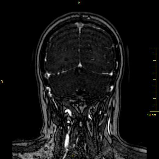 Cerebral venous thrombosis (Radiopaedia 23288-23351 MRV 139).JPG