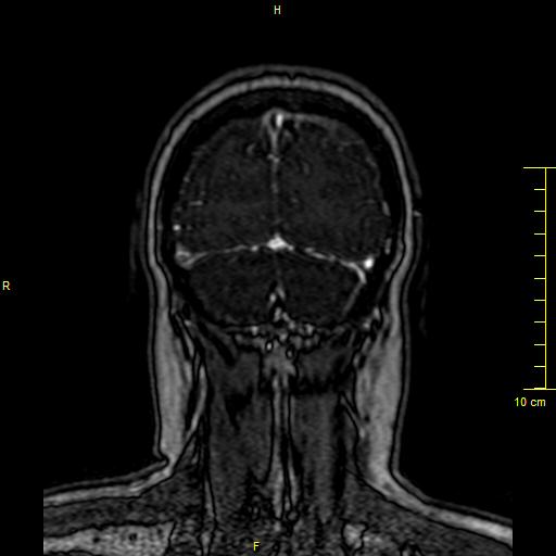 Cerebral venous thrombosis (Radiopaedia 23288-23351 MRV 155).JPG