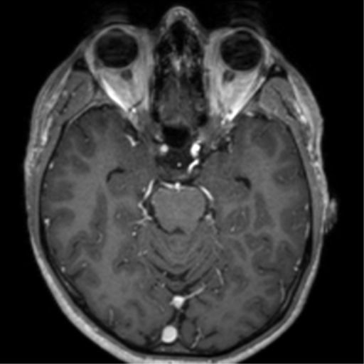 Cerebral venous thrombosis (Radiopaedia 38392-40469 Axial T1 C+ 31).png