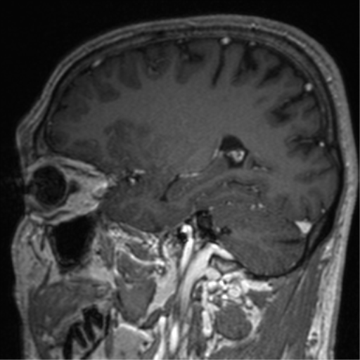 File:Cerebral venous thrombosis (Radiopaedia 38392-40469 Sagittal T1 C+ 60).png