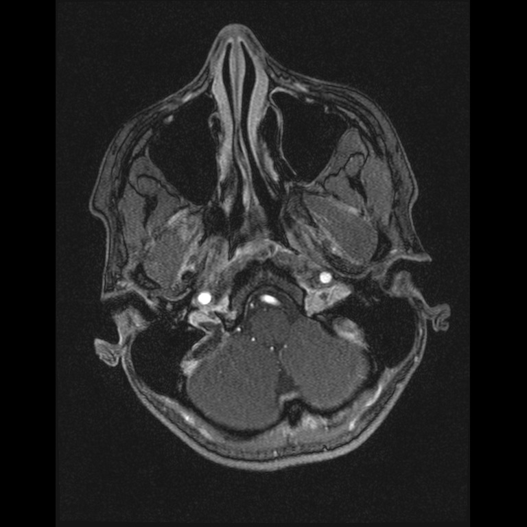 Cerebral venous thrombosis (Radiopaedia 45678-49854 Axial MRV 5).jpg