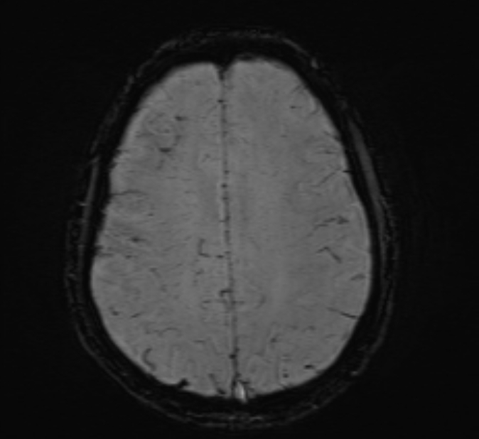 Cerebral venous thrombosis (Radiopaedia 71207-81504 Axial SWI 38).jpg
