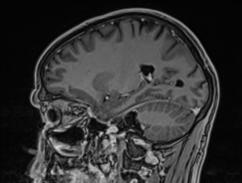 Cerebral venous thrombosis (Radiopaedia 71207-81504 Sagittal T1 C+ 21).jpg
