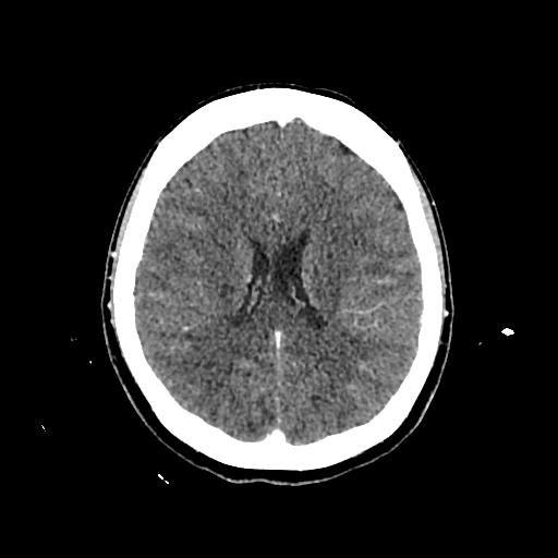 Cerebral venous thrombosis with venous hemorrhagic infarct (Radiopaedia 90354-107660 Axial with contrast 104).jpg