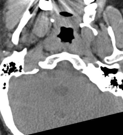 File:Cervical canal stenosis due to ossification of the posterior longitudinal ligament (Radiopaedia 47260-51823 Axial non-contrast 3).png