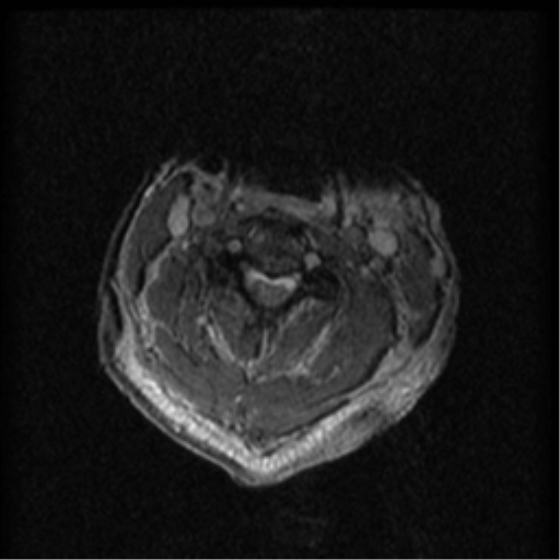 Cervical canal stenosis with cord compression (Radiopaedia 34114-35374 Axial Gradient Echo 58).png