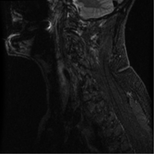 File:Cervical canal stenosis with cord compression (Radiopaedia 34114-35374 Sagittal STIR 12).png