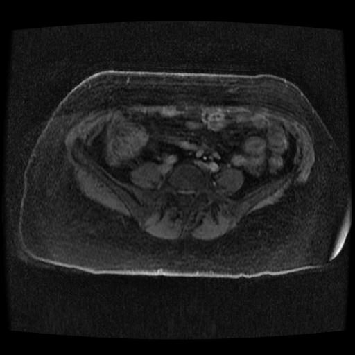 Cervical carcinoma (Radiopaedia 70924-81132 Axial T1 C+ fat sat 84).jpg