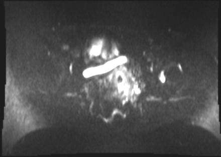 File:Cervical carcinoma (Radiopaedia 88312-104943 Axial DWI 13).jpg