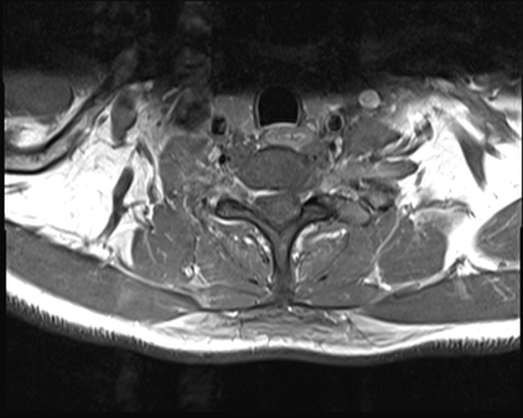 File:Cervical disc extrusion (Radiopaedia 53950-60077 Axial T1 C+ fat sat 24).jpg