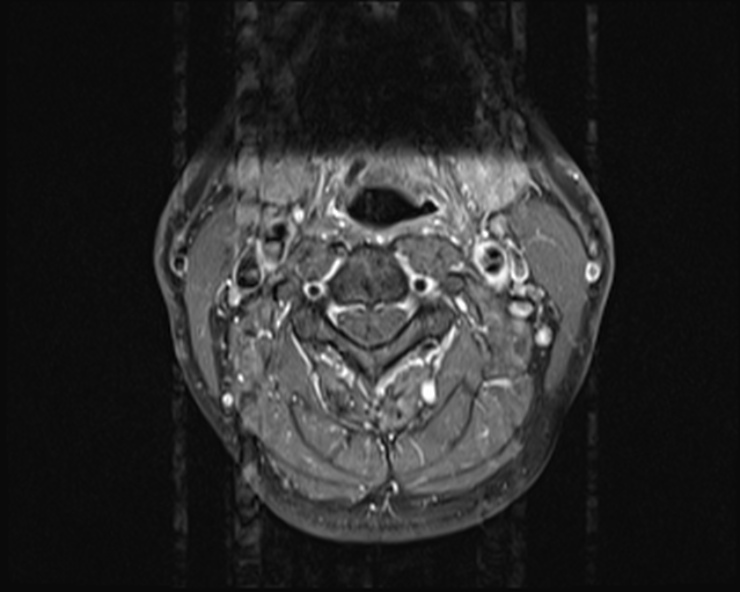 File:Cervical disc extrusion (Radiopaedia 53950-60077 Axial T1 C+ fat sat 6).jpg