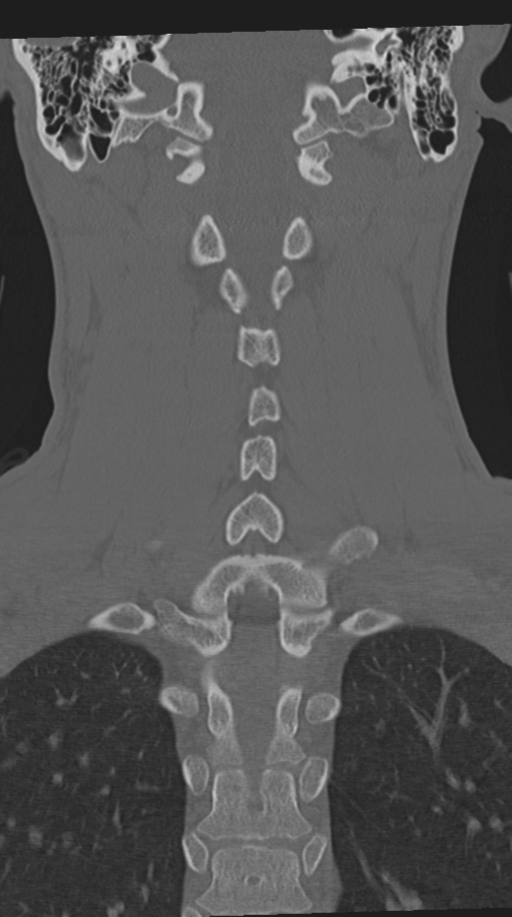 Cervical intercalary bone (Radiopaedia 35211-36748 Coronal bone window 49).png