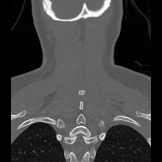 File:Cervical rib (Radiopaedia 71110-81363 Coronal non-contrast 12).jpg
