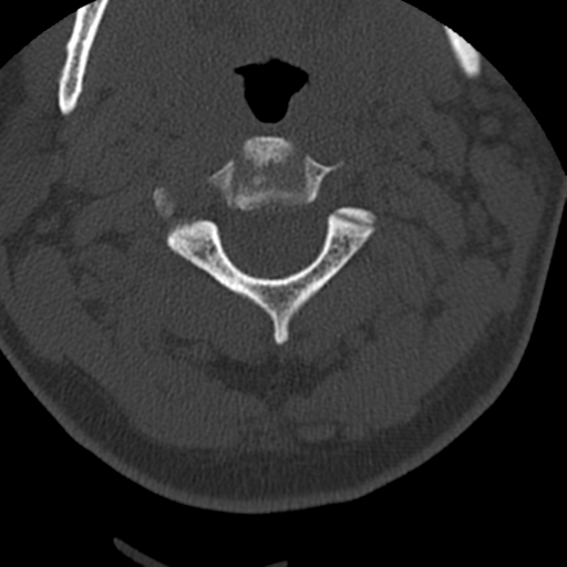 File:Cervical schwannoma (Radiopaedia 57979-64974 Axial bone window 17).png