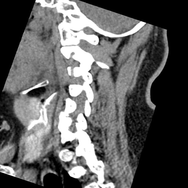 Cervical spinal neurofibroma in a patient with NF1 (Radiopaedia 58344-65464 C 35).jpg