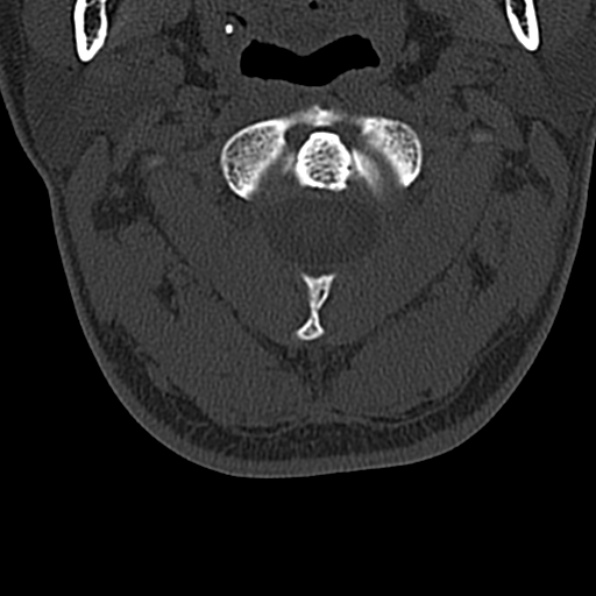 Cervical spondylodiscitis (Radiopaedia 28057-29489 Axial bone window 22).jpg