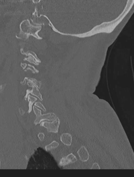 Cervical spondylolysis (Radiopaedia 49616-54811 Sagittal bone window 52).png