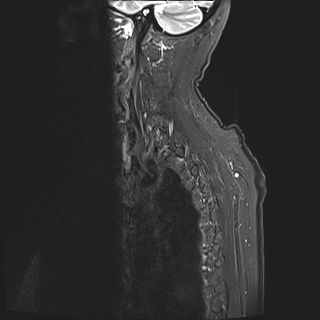 File:Cervical tumor-like myelopathy due to Type V dAVF (Radiopaedia 82461-96604 Sagittal STIR 1).jpg
