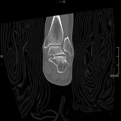 Chaput tubercle fracture (Radiopaedia 80319-93956 Coronal non-contrast 42).jpg
