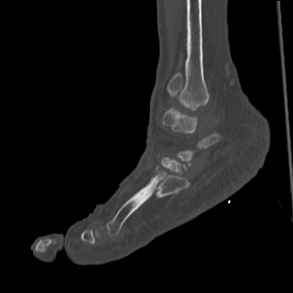 Charcot joint (Radiopaedia 36629-38194 Sagittal bone window 32).jpg