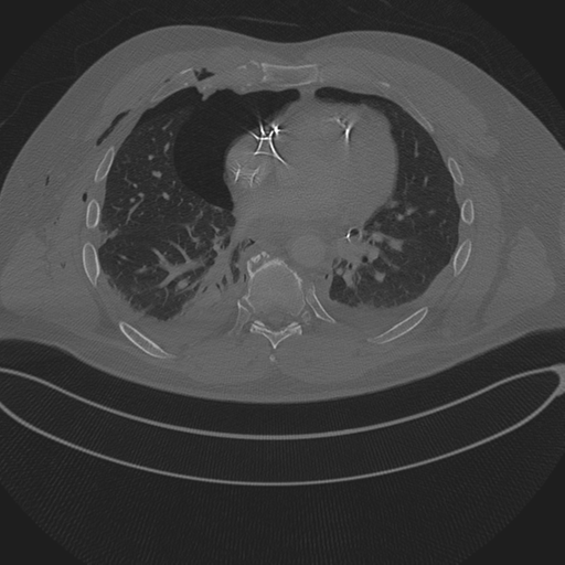 Chest multitrauma - aortic injury (Radiopaedia 34708-36147 Axial bone window 178).png