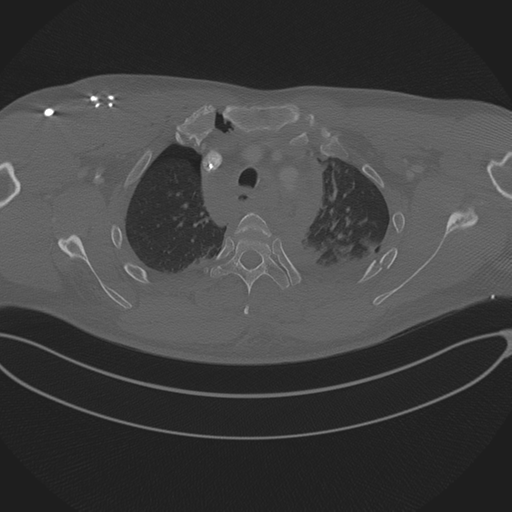 Chest multitrauma - aortic injury (Radiopaedia 34708-36147 Axial bone window 67).png