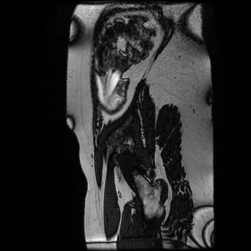 Chiari II malformation - fetal MRI (Radiopaedia 68099-77581 Sagittal Fiesta 3).jpg