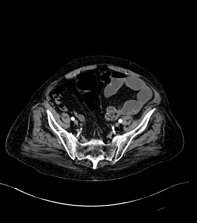 Cholangiocarcinoma with cerebral metastases (Radiopaedia 83519-98629 B 98).jpg