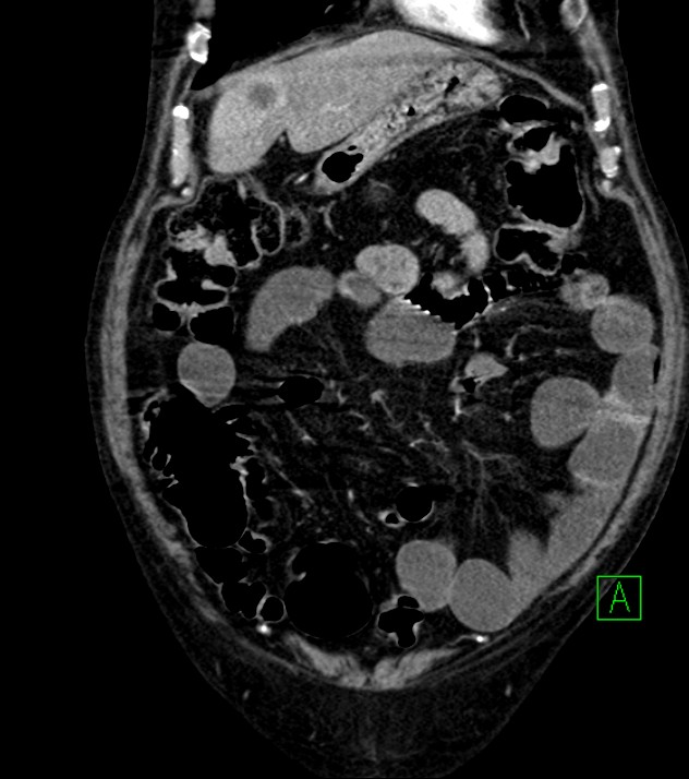 Cholangiocarcinoma with cerebral metastases (Radiopaedia 83519-98629 E 25).jpg