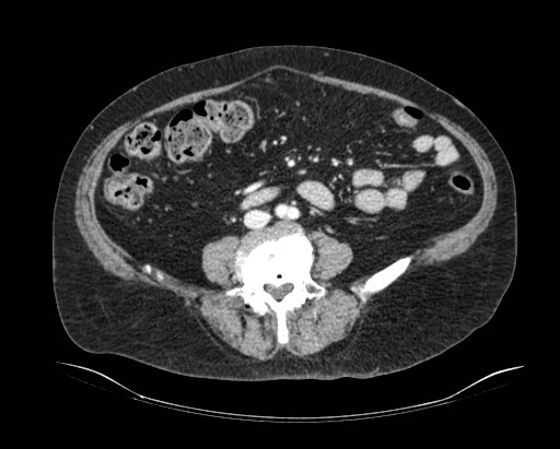 Cholecystoduodenal fistula (Radiopaedia 48959-54022 A 6).jpg