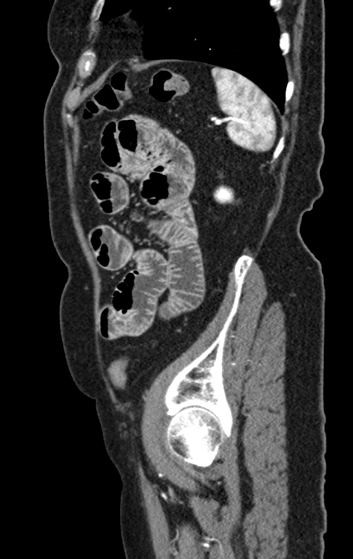 Cholecystoduodenal fistula due to calculous cholecystitis with gallstone migration (Radiopaedia 86875-103077 C 12).jpg
