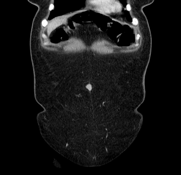 Choledocholithiasis on CT and MRI (Radiopaedia 24825-25087 C 7).jpg