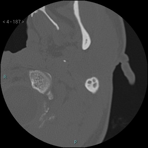 Cholesterol granuloma of the petrous apex (Radiopaedia 64358-73141 Axial bone window 90).jpg