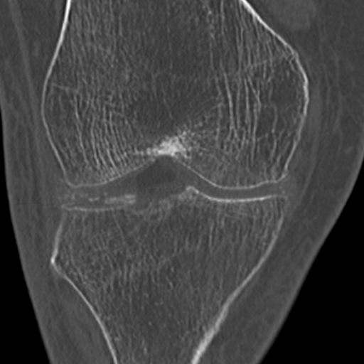 Chondrocalcinosis (Radiopaedia 16275-15955 Coronal bone window 27).jpg