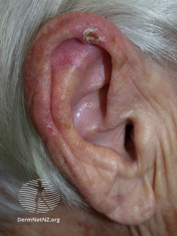 File:Chondrodermatitis nodularis helicis (DermNet NZ site-age-specific-ear-cnh2).jpg
