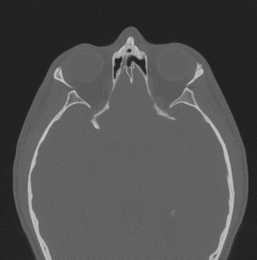 Chondrosarcoma (clivus) (Radiopaedia 46895-51425 Axial bone window 21).png