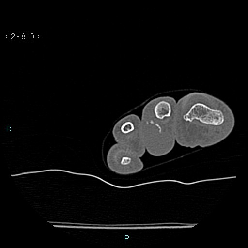 Chondrosarcoma - phalanx (Radiopaedia 69047-78812 Axial bone window 64).jpg