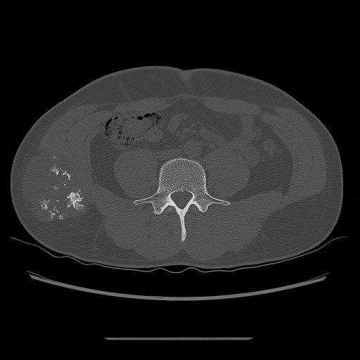 File:Chondrosarcoma of iliac wing (Radiopaedia 63861-72599 Axial bone window 23).jpg