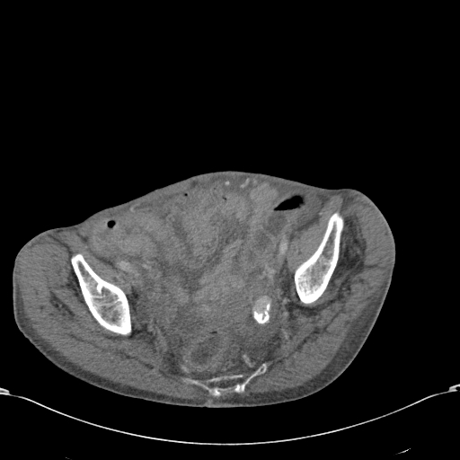 File:Chondrosarcoma of the spine (Radiopaedia 49871-55143 A 54).jpg