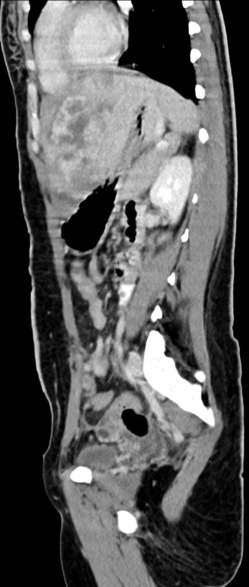 Choriocarcinoma liver metastases (Radiopaedia 74768-85766 C 80).jpg