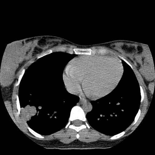 Choriocarcinoma of ovary with cerebral and pulmonary metastases (Radiopaedia 25983-26119 Axial non-contrast 9).jpg