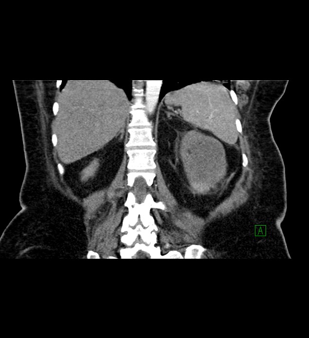 Chromophobe renal cell carcinoma (Radiopaedia 84239-99519 C 65).jpg