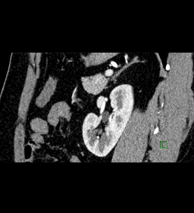 Chromophobe renal cell carcinoma (Radiopaedia 84286-99573 F 53).jpg