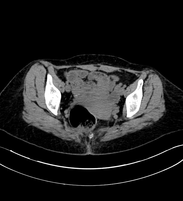 Chromophobe renal cell carcinoma (Radiopaedia 84290-99582 Axial non-contrast 131).jpg