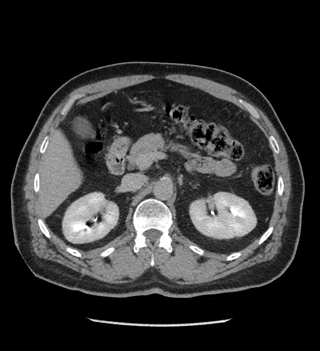 Chromophobe renal cell carcinoma (Radiopaedia 86879-103083 D 48).jpg