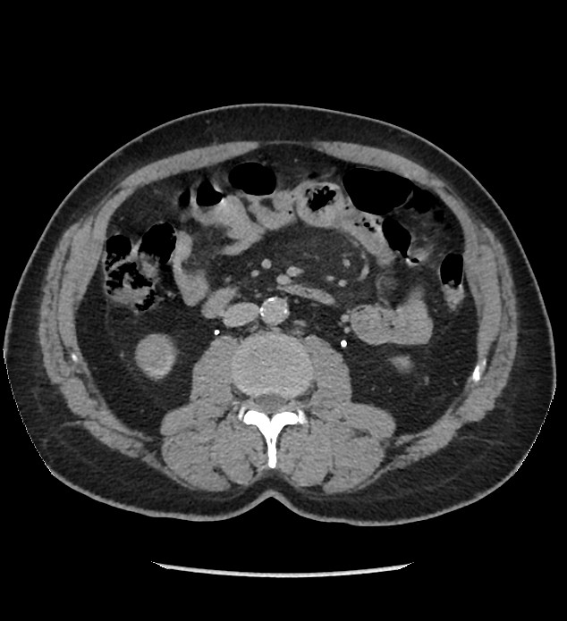 Chromophobe renal cell carcinoma (Radiopaedia 86879-103083 D 71).jpg